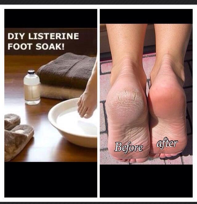 Listerine Foot Soak Perfect For Dry Cracked Feet Trusper